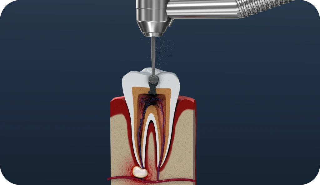 Dévitalisation dentaire