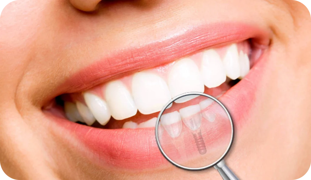 Extraction implantation immédiate