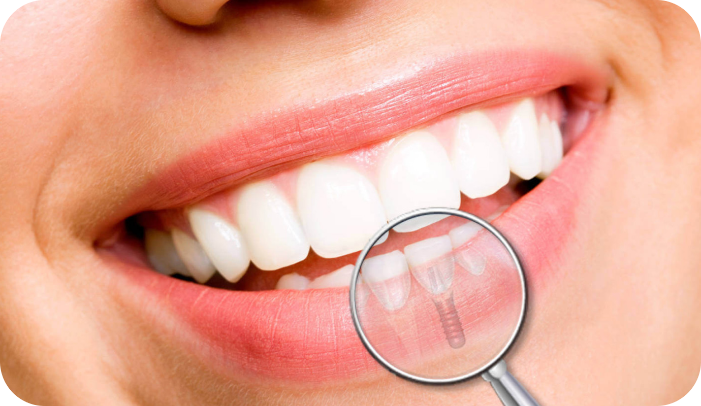 Extraction implantation immédiate au cabinet dentaire à Villié Morgon