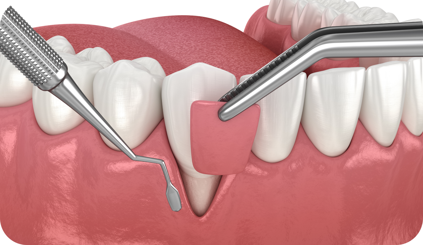 Greffe de gencive au cabinet dentaire à Villié Morgon