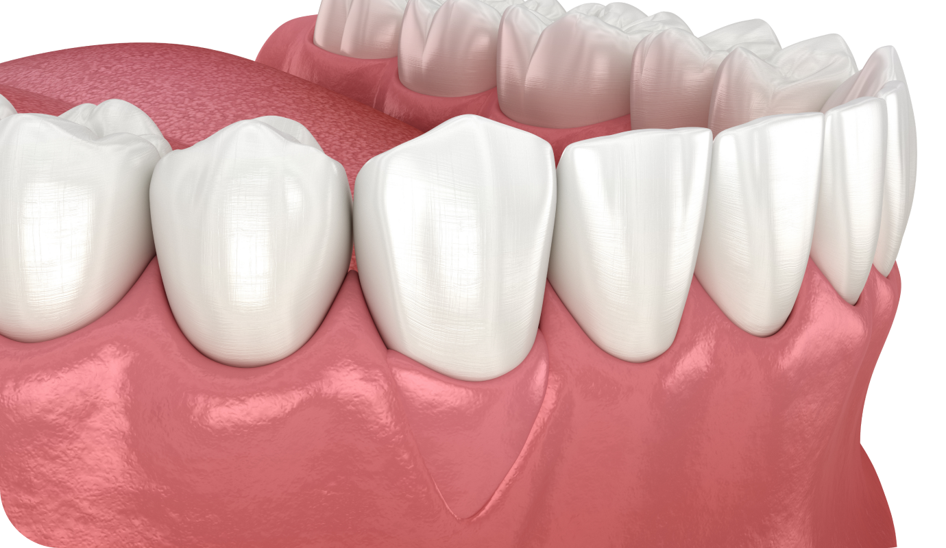 Greffe de gencive au cabinet dentaire à Villié Morgon