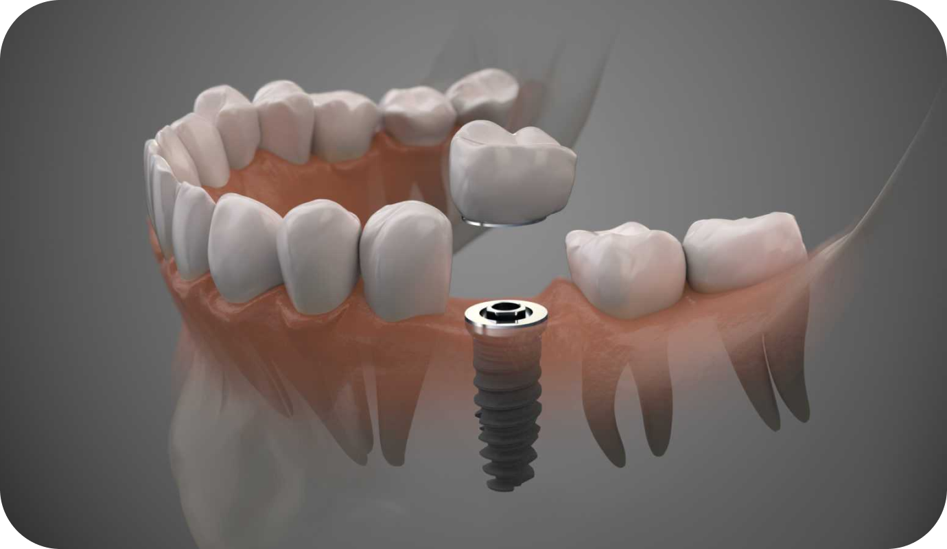 Implant unitaire au cabinet dentaire à Villié Morgon