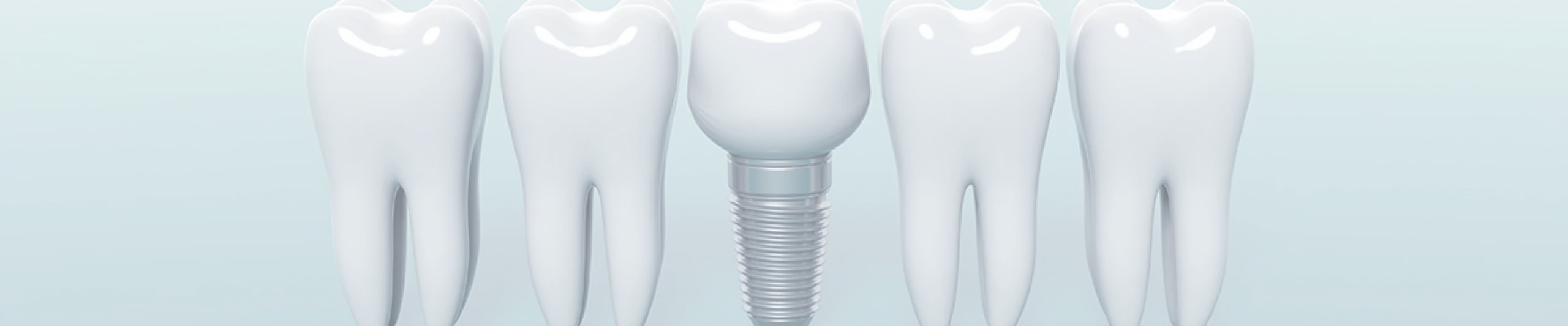 Implantologie au cabinet dentaire à Villié Morgon