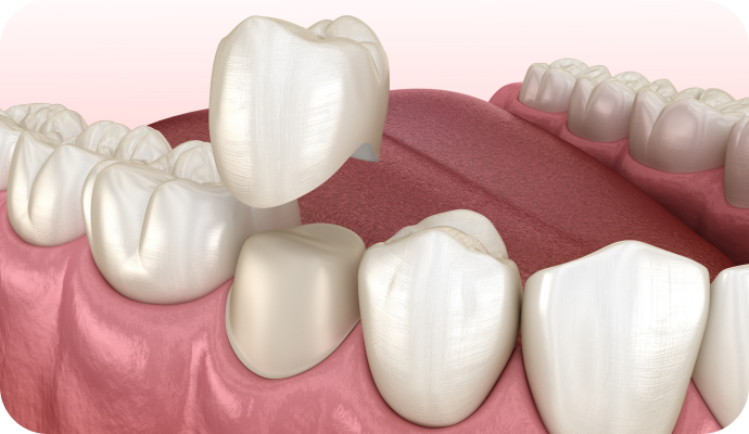 Inlay / Onlay au cabinet dentaire à Villié Morgon