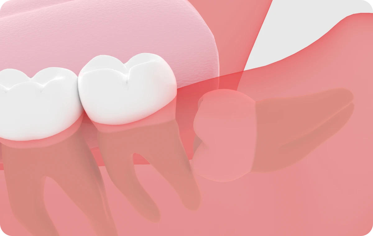 Recommandations après votre extraction au cabinet dentaire à Villié Morgon