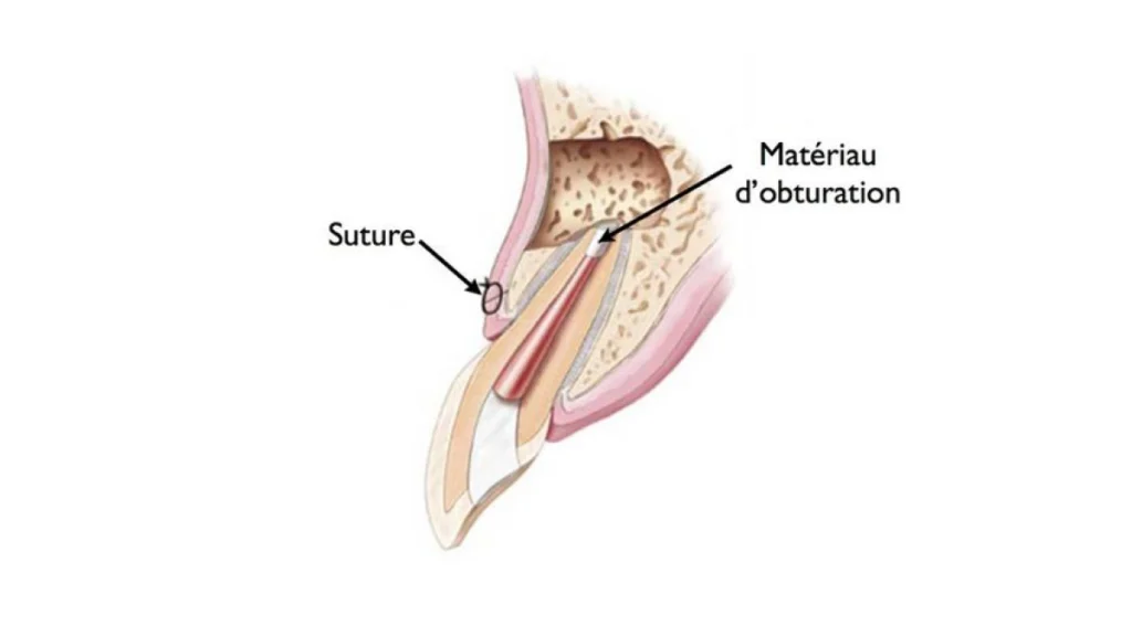 Micro chirurgie endodontique